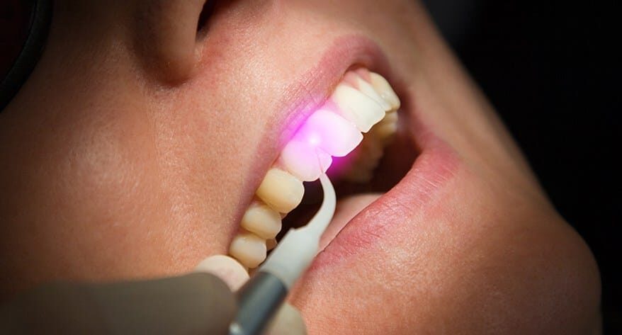 Laser dentistry